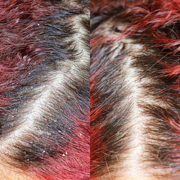 Scalp Care For Curls: Your Scalp Transformations Are In!
